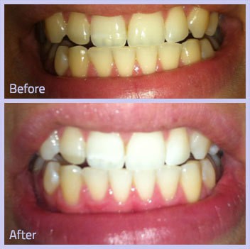 Bleach Bright Teeth Whitening - Solarium Super Tanning Salon