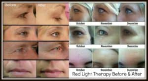 Red light therapy before and after image